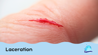 Laceration